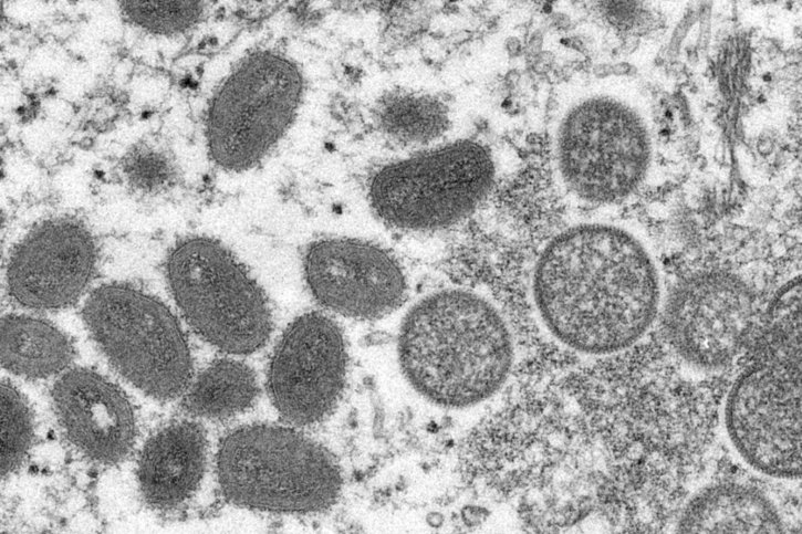 Les symptômes de la variole du singe ressemblent, en moins grave, à ceux de la variole: fièvre, maux de tête, douleurs musculaires, dorsales, au cours des cinq premiers jours. Apparaissent ensuite des éruptions cutanées, des lésions, des pustules et enfin des croûtes (archives). © KEYSTONE/AP